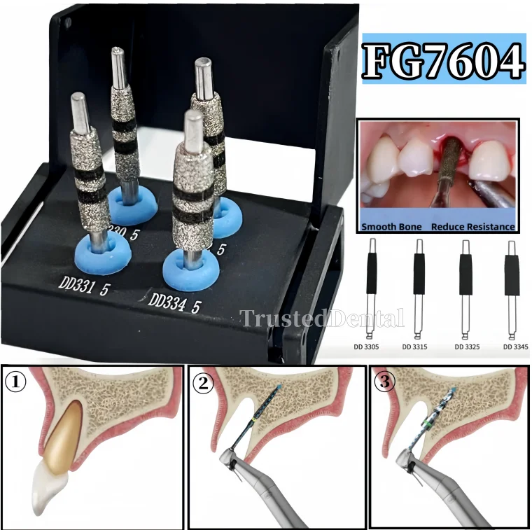 

Стоматологическая дрель для костной гусеницы, функция шлифования, вставка в растениях, сверла для коррекции шеи с направляющими, алмазная шлифовальная лента FG7604