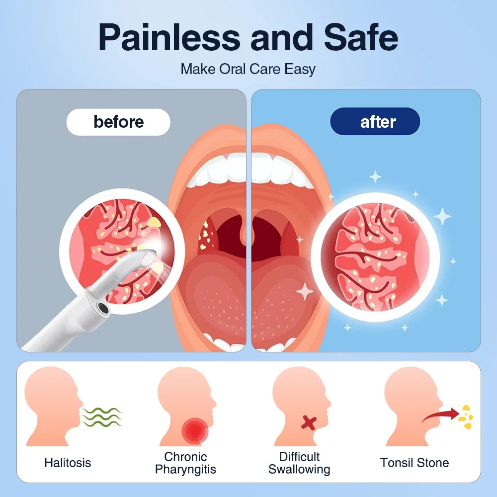 전기 시각적 토3개의 관개 주사기 즉각적인 흡입 토니일 제거를 가진 토니일 제거 장비 진공 300K HD 사진기