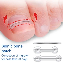 2Pcs Ingrown Toenail Correction Tool Ingrown Toe Nail Treatment Elastic Patch Sticker Straightening Clip Brace Pedicure Tool