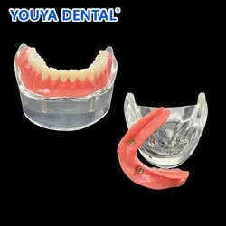 Dental Overdenture Teeth Model 2 Implants Demo Model 6002 Removable Restoration Dentist Student Learning Lower Model