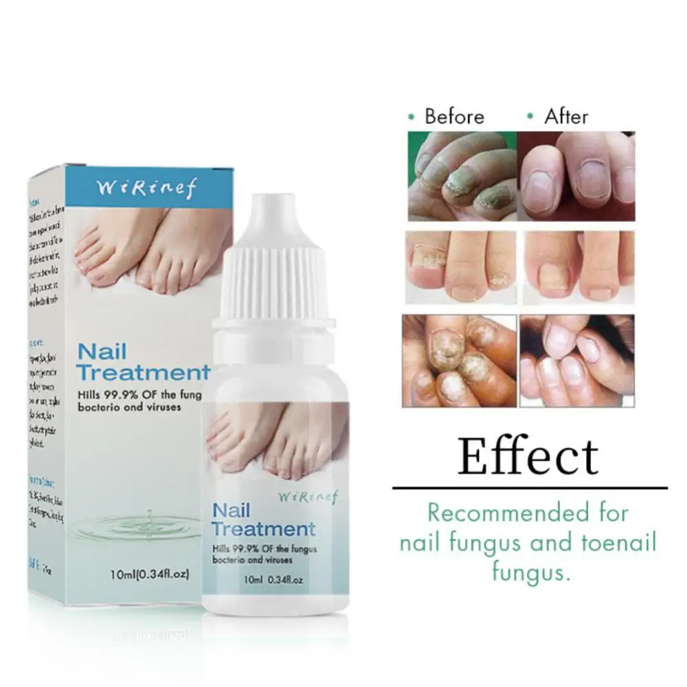 Onychomycosis Gel Visible Results Clinically Proven Powerful Bestselling Premium Top Rated Toenail Fungus Remover For Women