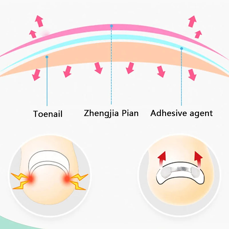 Universelle abziehbare ein gewachsene Zehen nagel Glättung sclip elastische Patch Zehen nägel Pflege Korrektor Patch Klammer Pediküre Werkzeuge