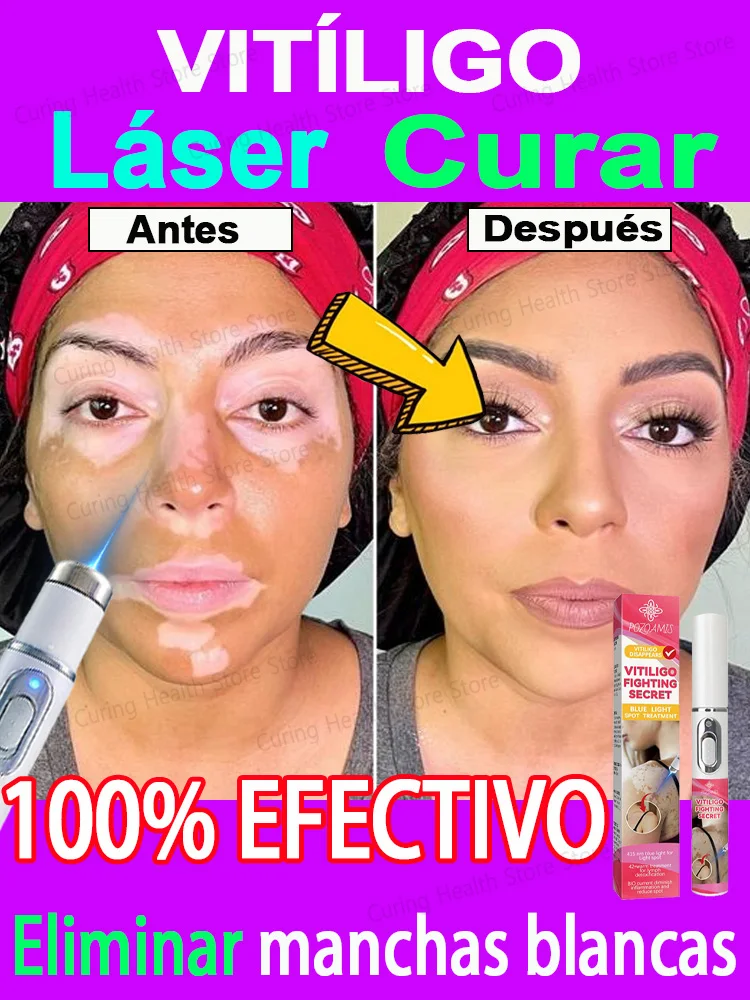 laser vitiligo