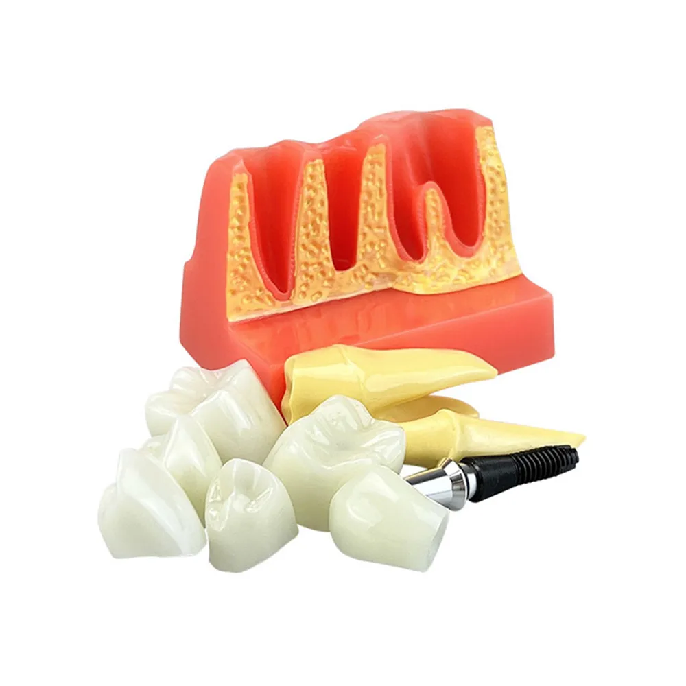 Diş Implant modeli 4 kez Implant analizi taç köprüsü çıkarılabilir Model diş hekimliği gösteri diş çalışması Model beyin