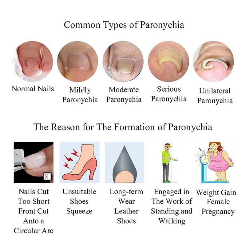 Paroníquia-Ingrown Toenail Pedicure Ferramenta, Clipe de alisamento, Curvo B Brace, Grosso Paroníquia Ferramenta Correção, Hot, Garrafa, 10Pcs