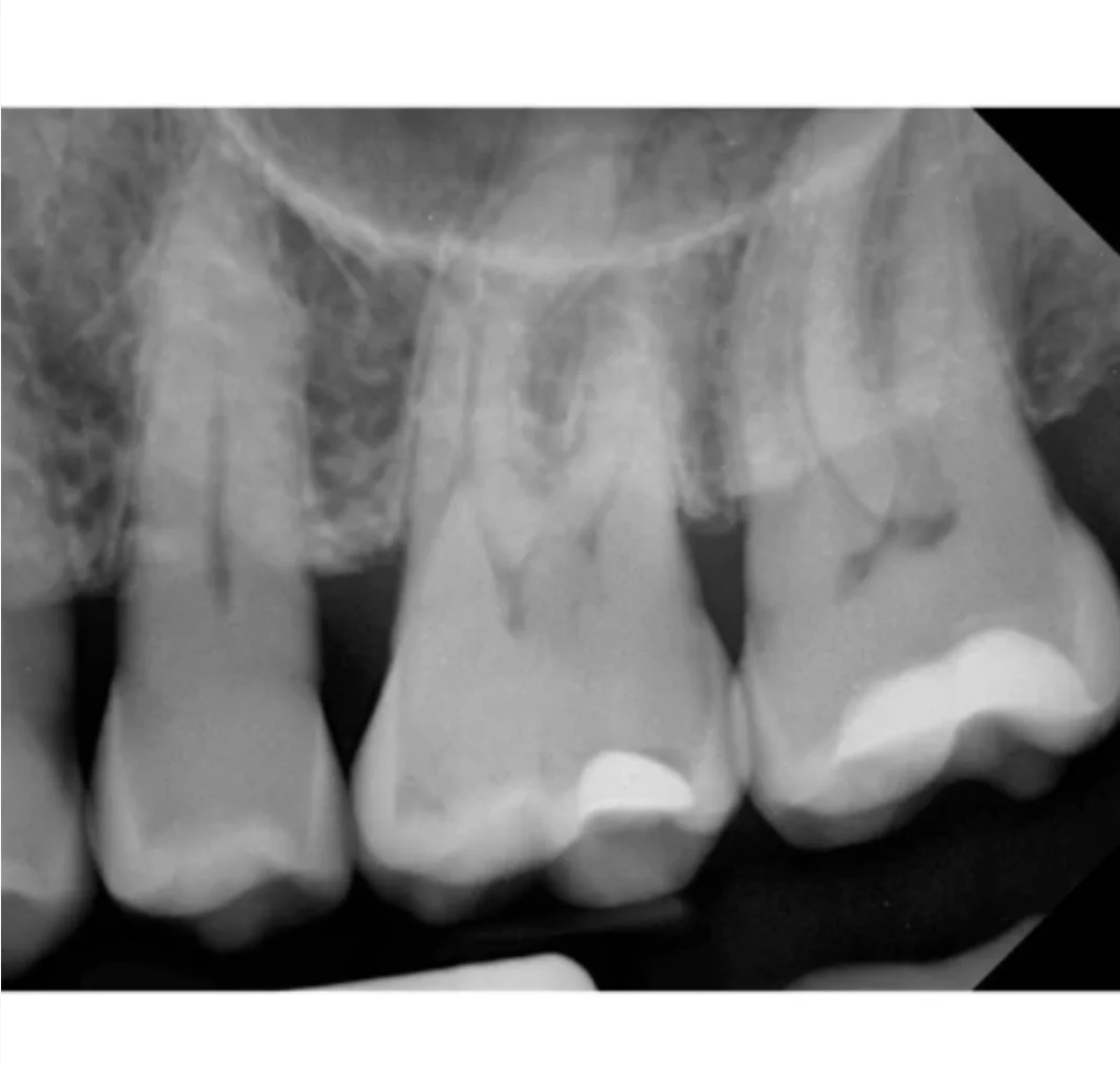 2025 NEW iRay Dental Digital Oral X-Ray imaging system 20μm pixel Pluto 0000X CMOS Sensor Size0/1/1.5/2 IP68 with 1year Warrant