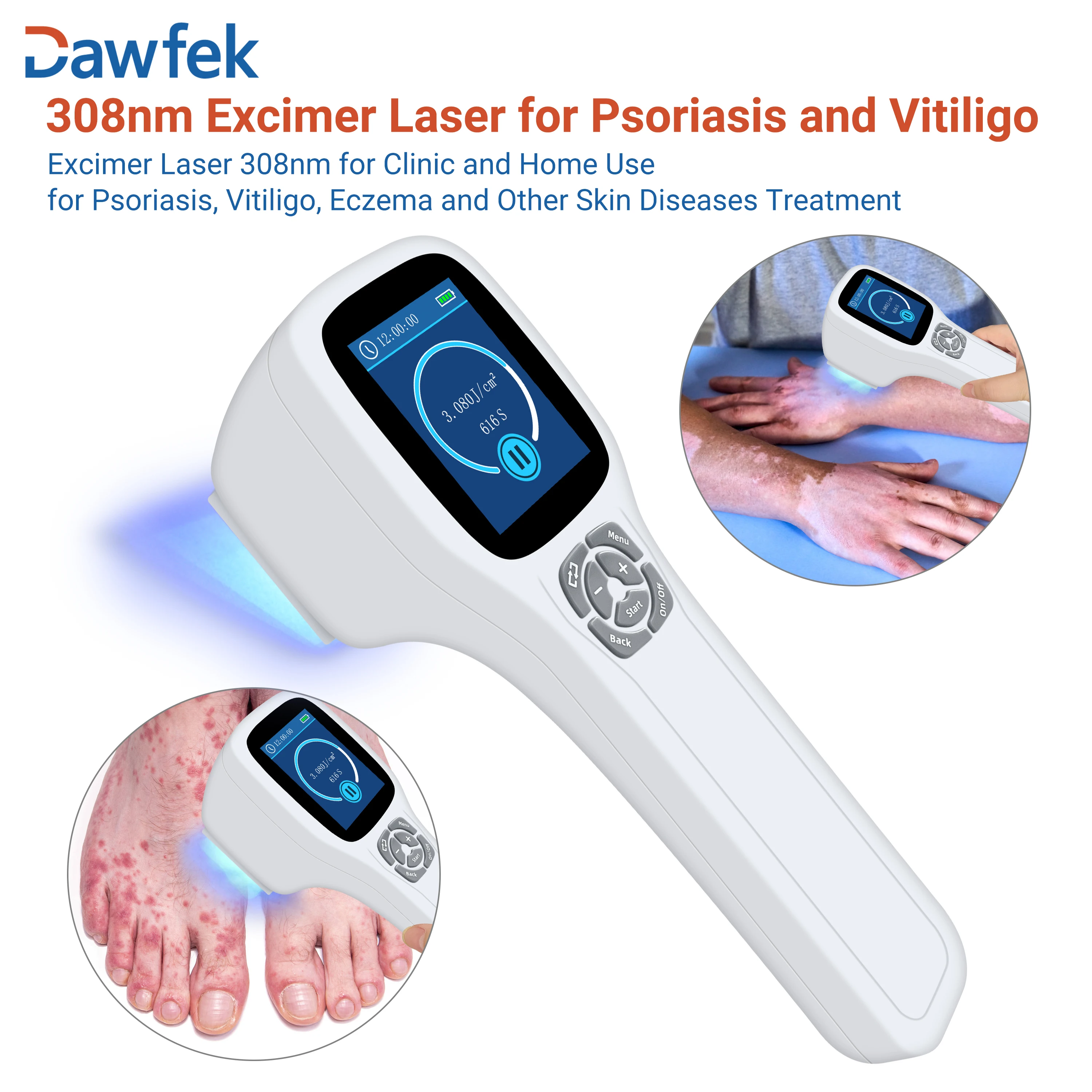 Dawfek Portable UV Light 308nm Vitiligo Skin Rejuvenation UV Light to Treat Psoriasis Led Light Benefits for Skin Dermatitis