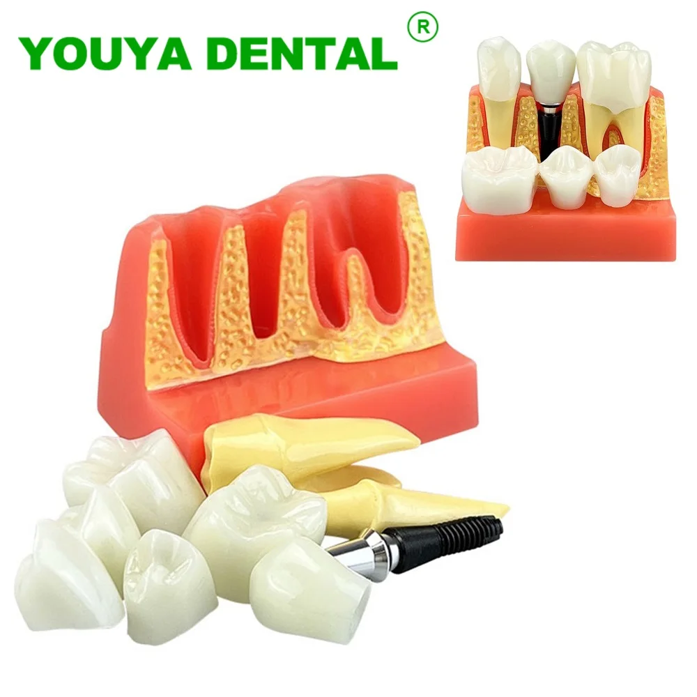 Dental Training Model 4 Times Teeth Implant Analysis Crown Bridge Removable Model For Dentistry Medical Science Teaching Study