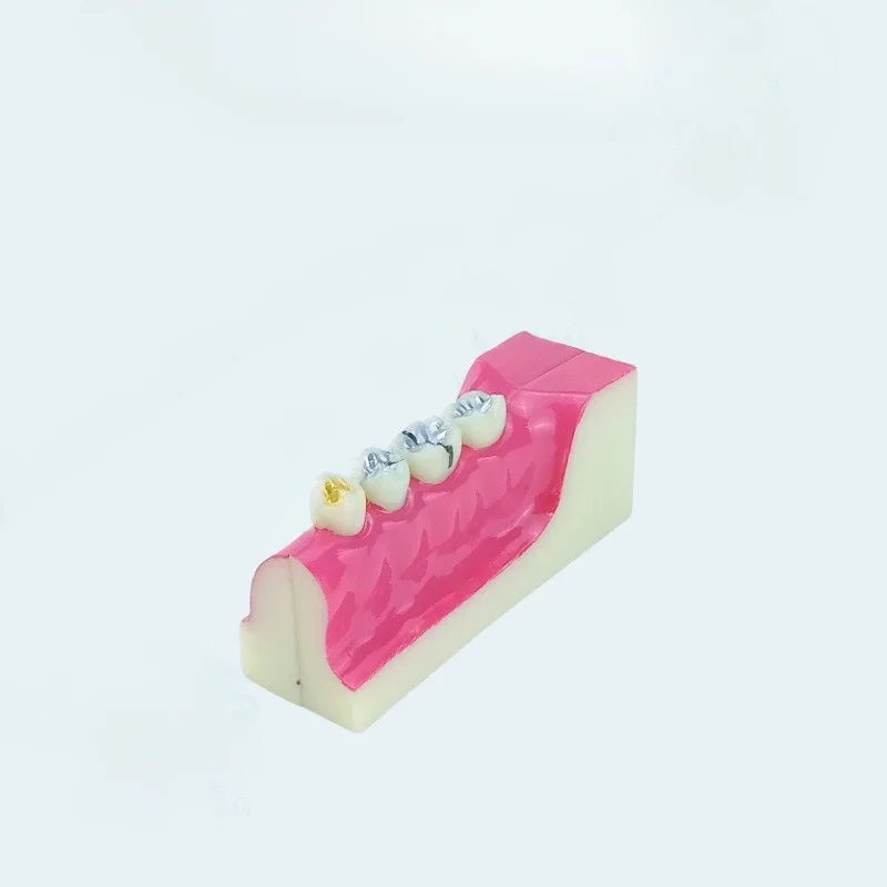 Dental Oral Dental Model Right Posterior Dental Tissue Decomposing Oral Demonstrating Doctor-patient Communication