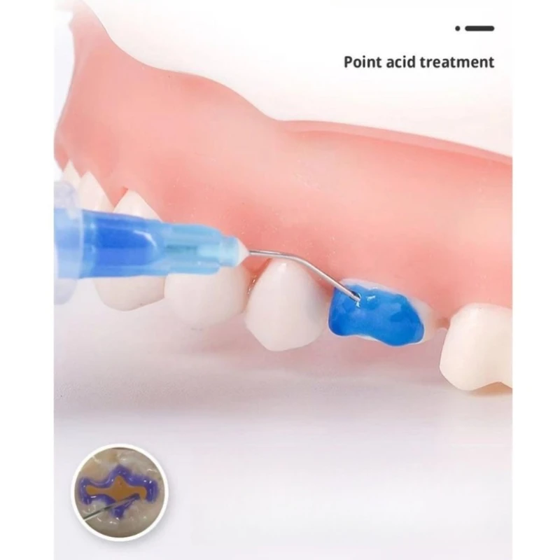 5 قطعة مواد طب الأسنان 37% جل النقش بحمض الفوسفوري 2.5 مللي/5 مللي تبييض الأسنان القشرة حمض النقش وكيل مواد طب الأسنان