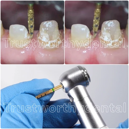 Imagen 2 del producto Preparación Dental fresa BOPT Kit de restauración de preparación Dental Vertical herramientas dentales de restauración de corona completa FG7906