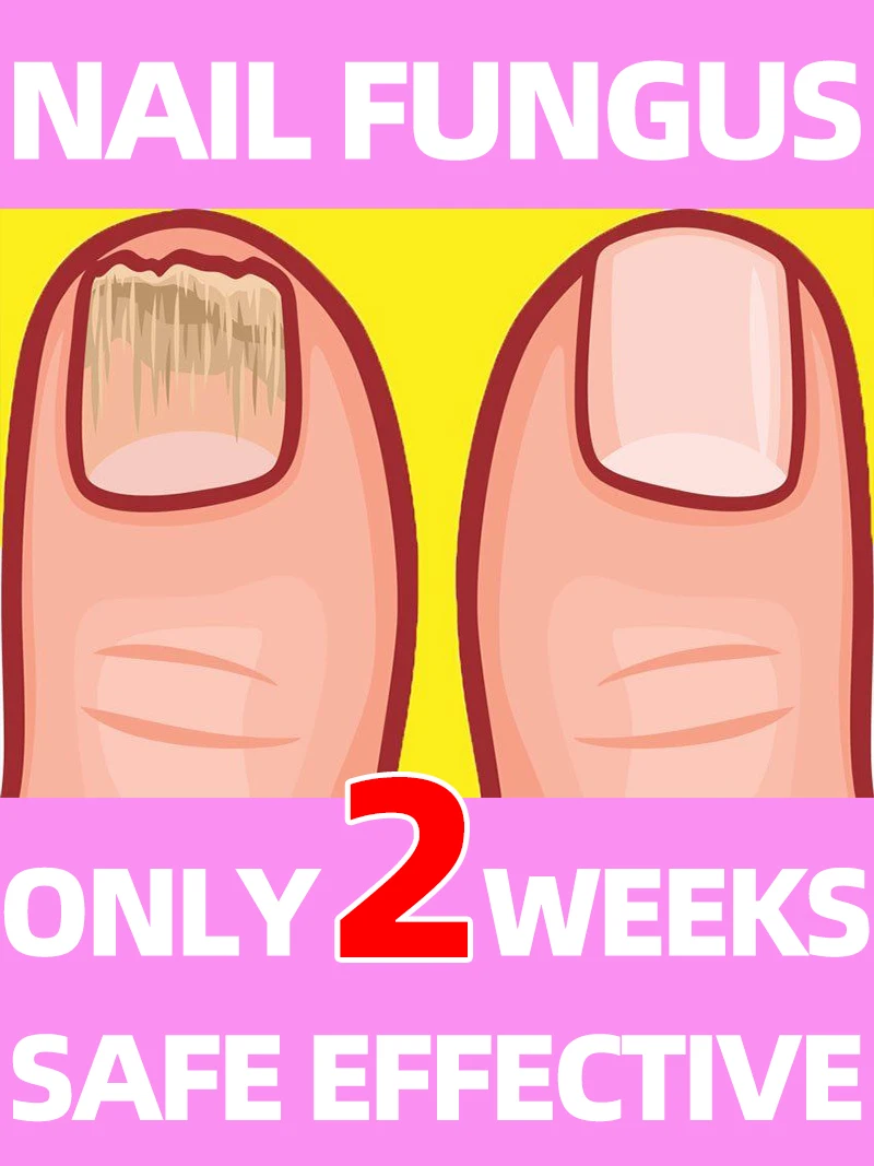 

nail fungus thickener growth