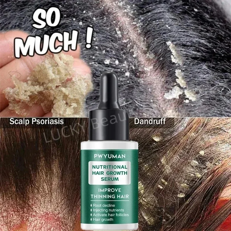 علاج فروة الرأس جوهر رذاذ القشرة الحكة السيطرة على النفط مكافحة فقدان فروة الرأس تنظيف إصلاح مصل منتجات العناية بالشعر الجمال