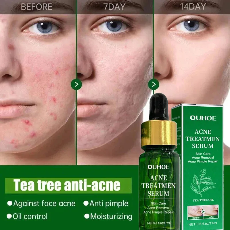 Acne Behandeling Gezicht Serum Porie Krimpende Huidverzorging Tegen Gezicht Acne Puistje Vlekken Verwijderaar Cleaning Krimpt Poriën Tea Tree Serum