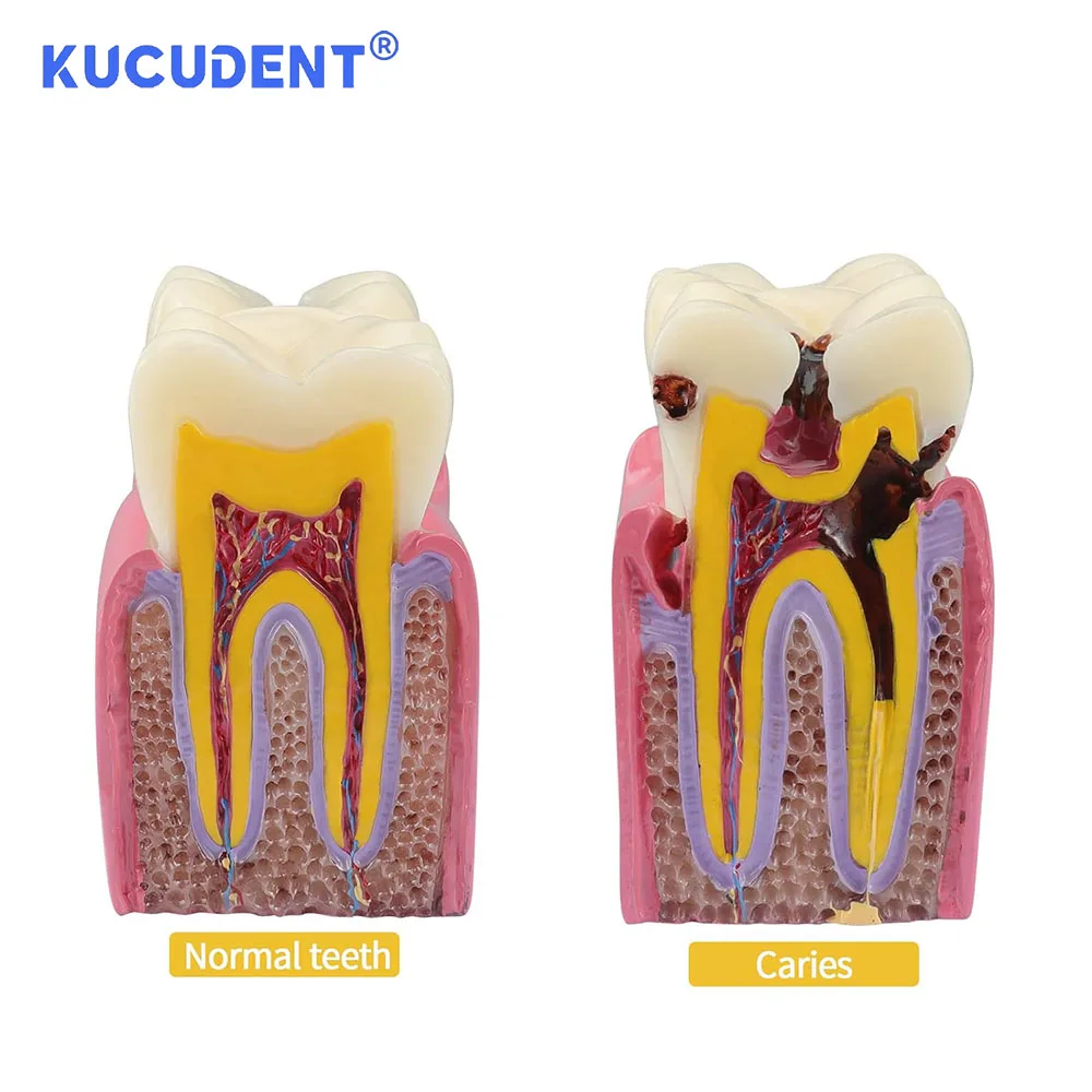 KUCUDENT Dental 6 Times Caries Teeth Model Student Studying Dentist Teaching Comparation Demonstration Training Researching