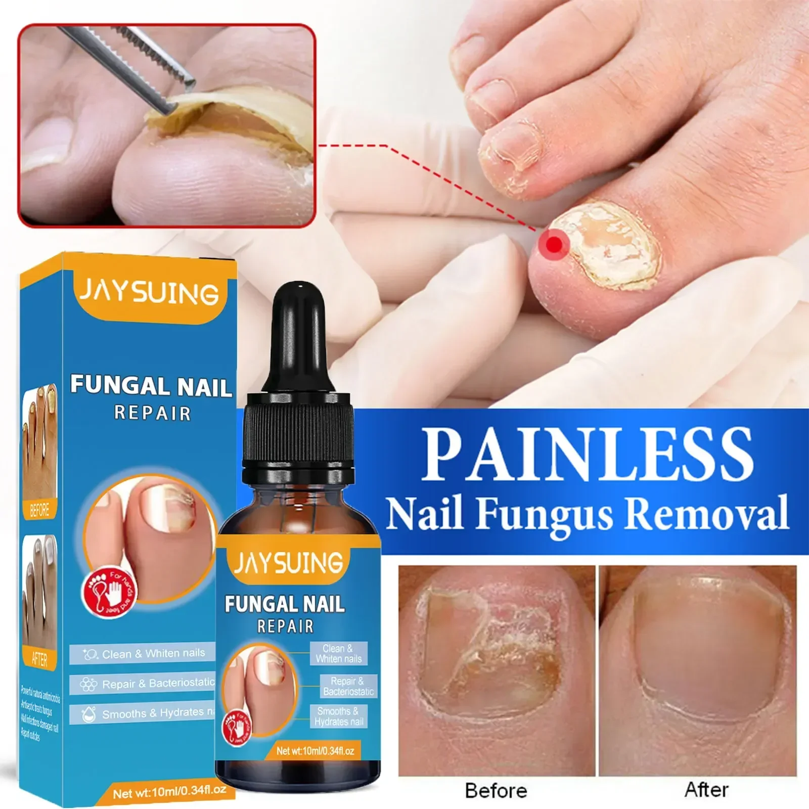 NewNail Fungal Treatment Feet Care Essence Repair Nail Fungus Removal Serum Gel Anti Infection Paronychia Onychomycosis0903