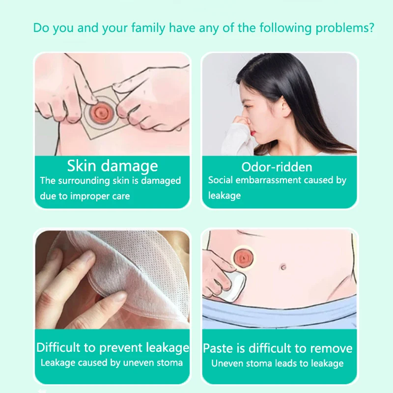 60 جرام مسحوق العناية بالبشرة ملحقات ستوما بعد الجراحة كريم أداة حاجز لصق مانع للتسرب لحقيبة الفغرة المضادة للمرهم