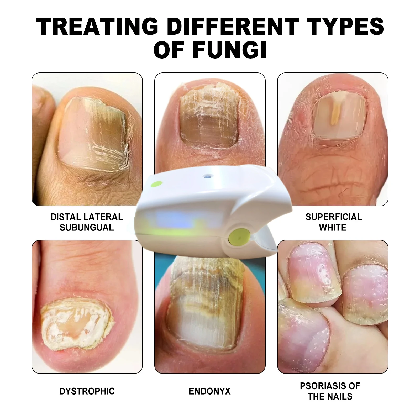 

Лазерное устройство для ногтей от грибка, ремонт ногтей, онихомикоза, против инфекции, терапия вросших паронихии, лечение ногтей на ногах, уход за ногтями