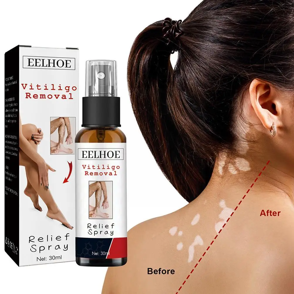 30ml Vitiligo Repair Spray Skin Moisturizing Vitiligo Skin Body White Spot Remove Fades Spots Spray Vitiligo Face Relief Ne J5I0