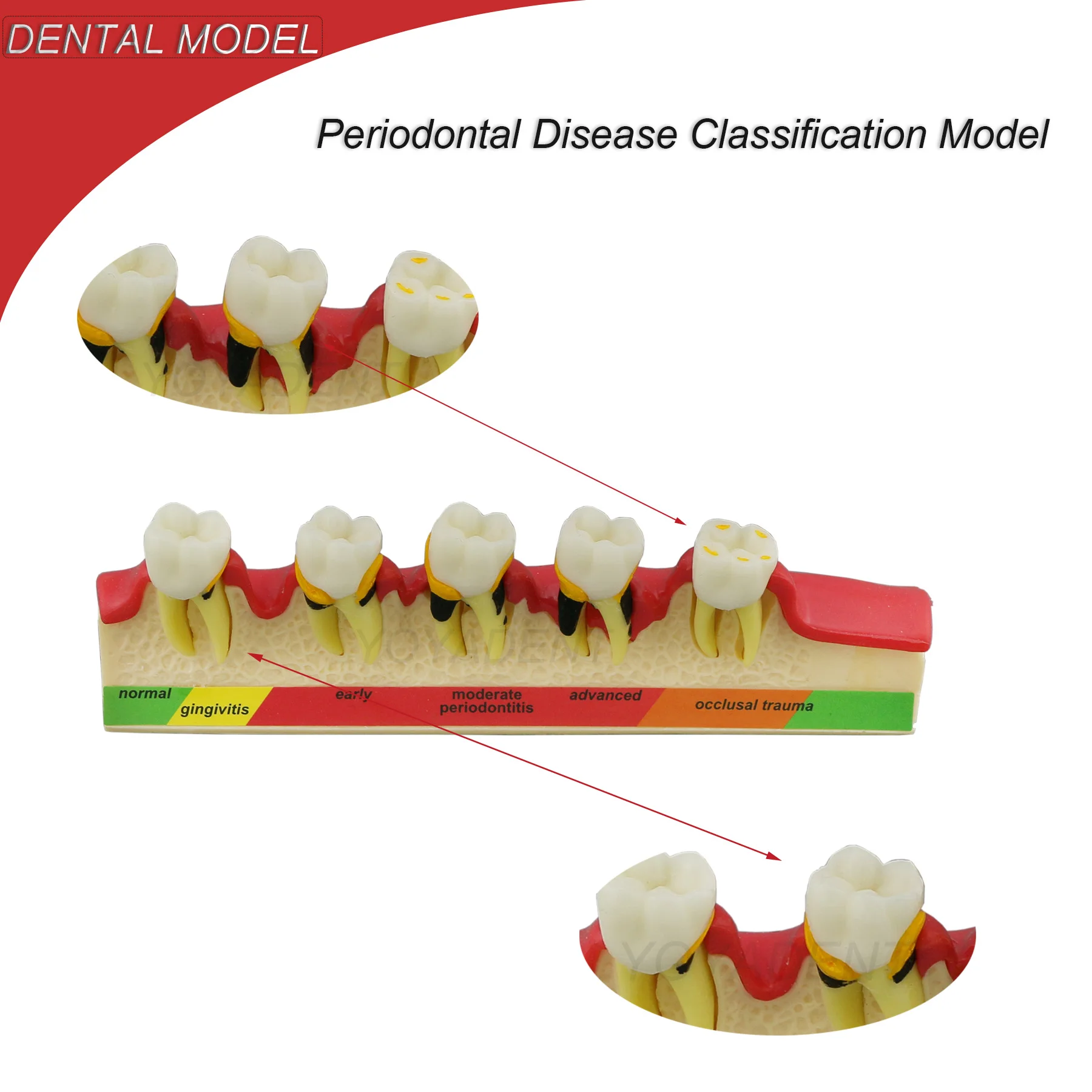 

Dental Model Periodontal Disease Model Caries Demo Model 5 Stages Dentisty Study Training Teaching Demo Tools M4010