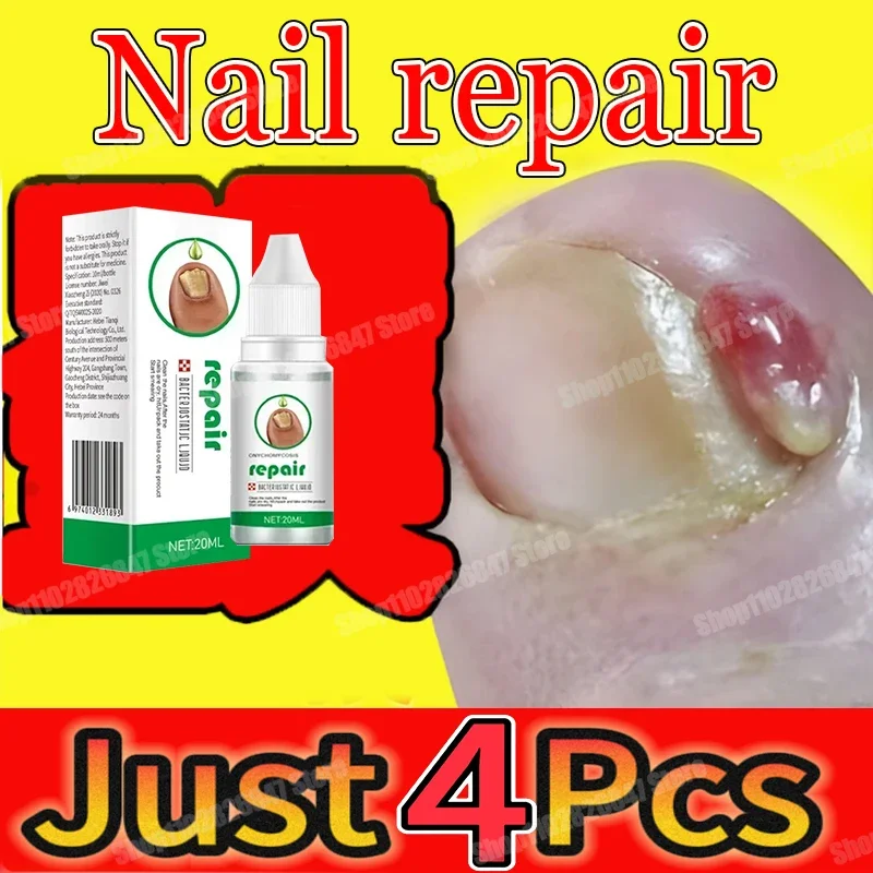 

Nail Fungus Treatment Serum Toe Fungal Repair Products Hand Foot Care Removal Gel Anti Infection Onychomycosis Paronychia
