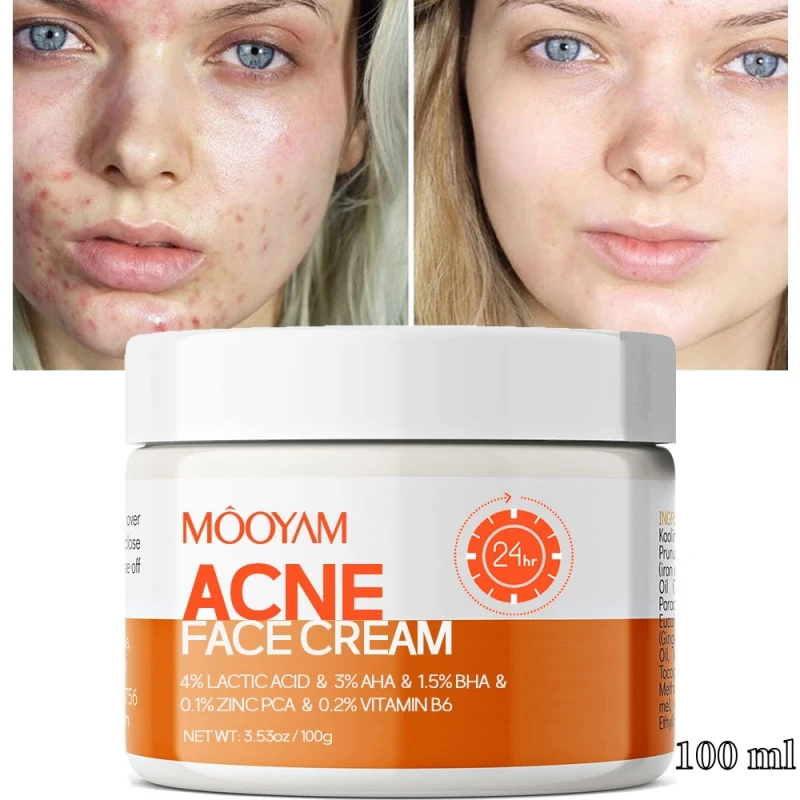 Crema facial Herbal para eliminación de acné, tratamiento de Gel antiacné, contracción de poros, elimina los poros grandes, manchas de granos, blanqueamiento, cuidado de la piel