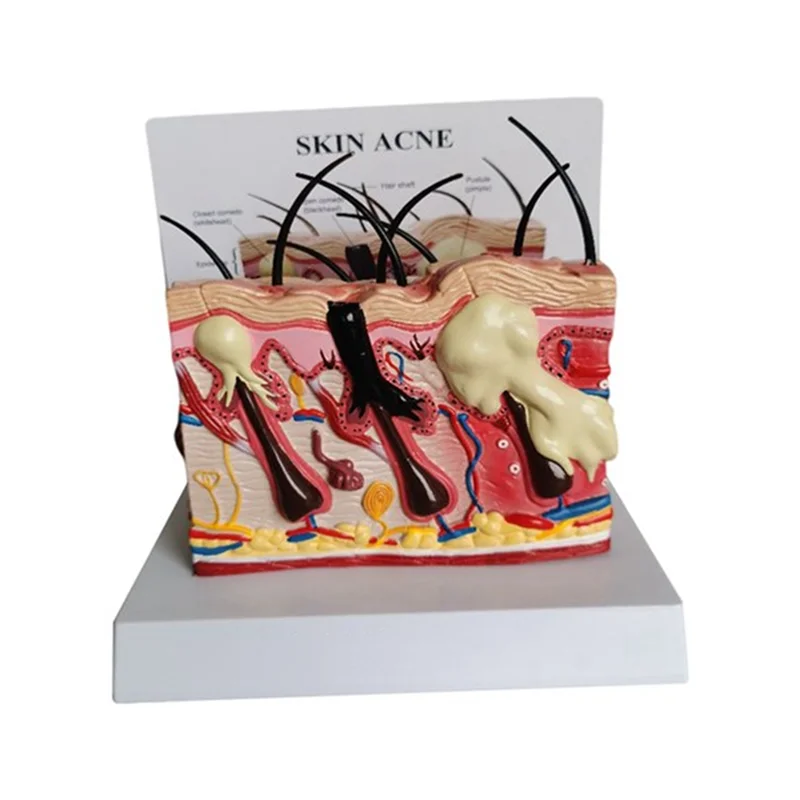 

Эффективная модель прыщей на коже, анатомия человека, нормальная общая кожа от прыщей, физиотерапевтическое образование, анатомическая модель