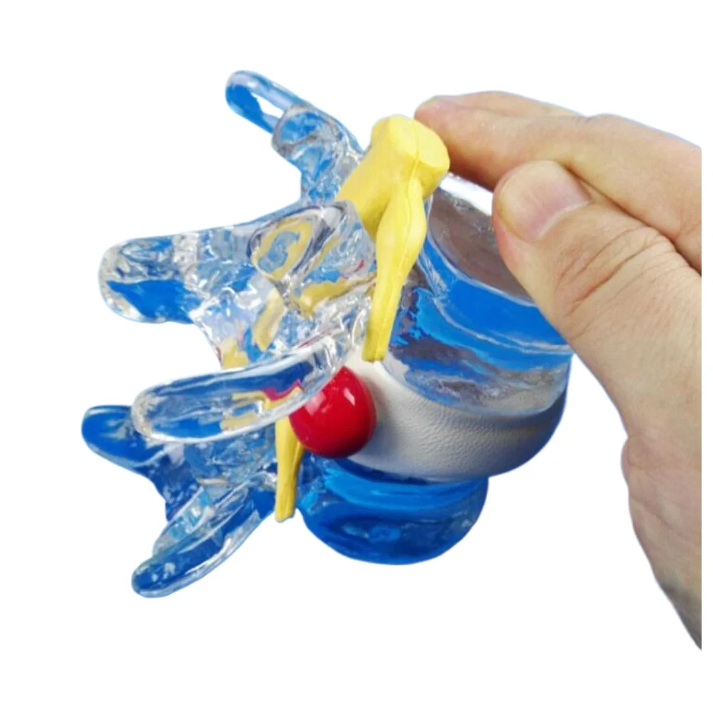 Spine and Spinal Cord Extrusion Disc Herniation, Lumbar Disc Demonstration Model, Lumbar Spine Model New Product