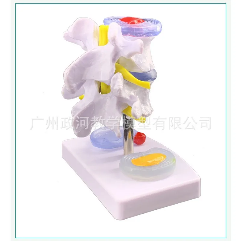 Human Lumbar Disc Herniation Anatomy Model Skeletal Pathology