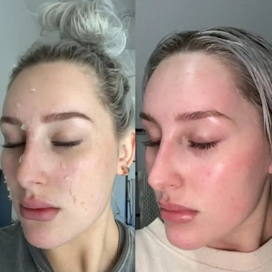Acid Peeling Serum Chemical Exfoliant Peel for remove Face Dark Skin Spots Whiten Lighten Melanin Peeling Solution Skin Peel