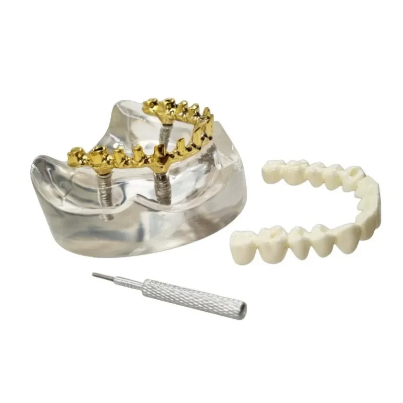 PP All-on-4 Lab Model | Implant Supported Bridge | Full Arch Teeth Replacement | Adjustable Resin Material