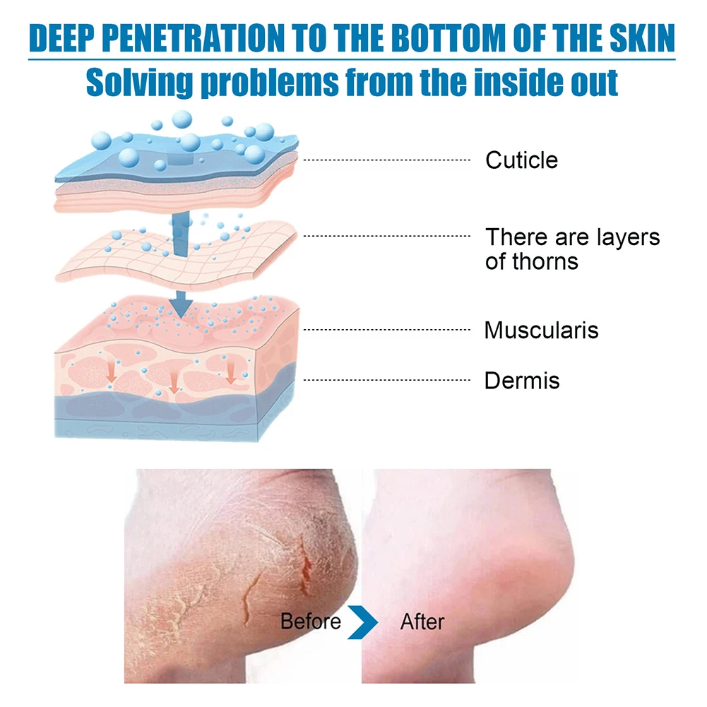 1 زوج قناع تقشير الجلد العناية بالقدمين التقشير الكالس الجوارب يغذي معتدل ترطيب القدم سبا العناية بالبشرة