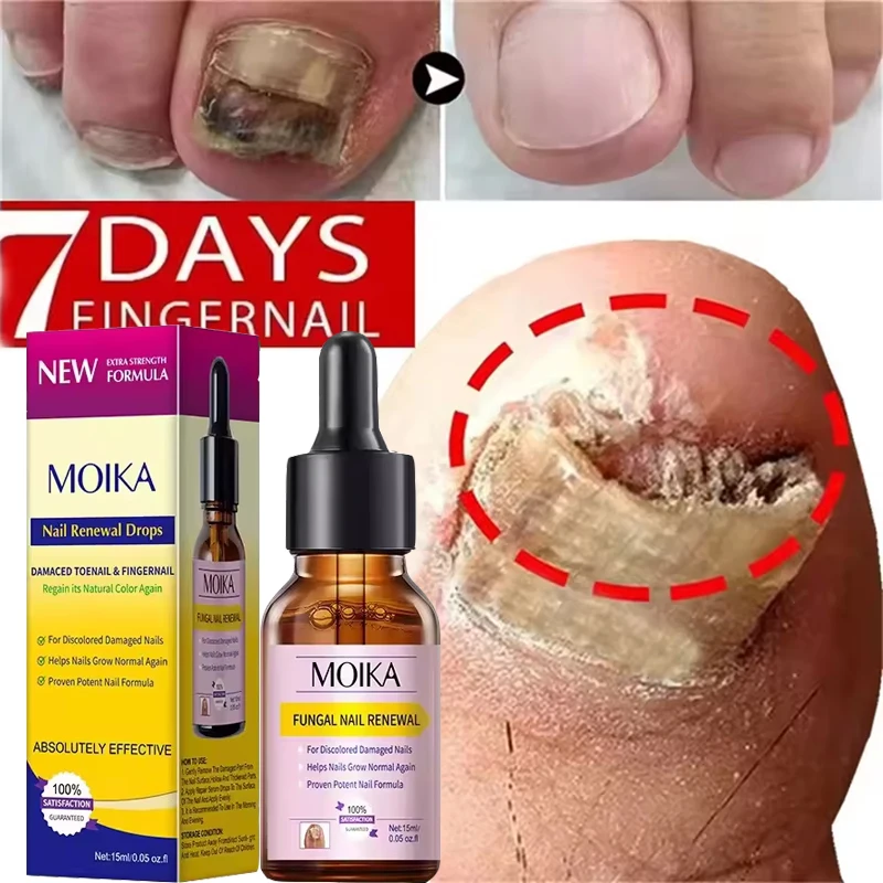 Fungal Nail Treatment Serum Foot Nail Fungus Removal Repair Gel Anti Infection Paronychia Onychomycosis Foot Nails Care Essence