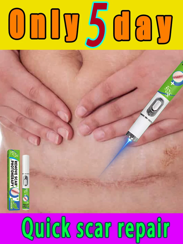 

Tʜᴇ sᴄᴀʀ ʀᴇᴍᴏᴠᴀʟ ʙʟᴜᴇ ʟɪɢʜᴛ ʟᴀsᴇʀ ᴘᴇɴ ᴄᴀɴ ᴇᴀsɪʟʏ ʀᴇᴍᴏᴠᴇ sᴄᴀʀs ᴀɴᴅ ᴋᴇᴇᴘ ʏᴏᴜ ᴀᴡᴀʏ ғʀᴏᴍ sᴄᴀʀ ᴛʀᴏᴜʙʟᴇs.