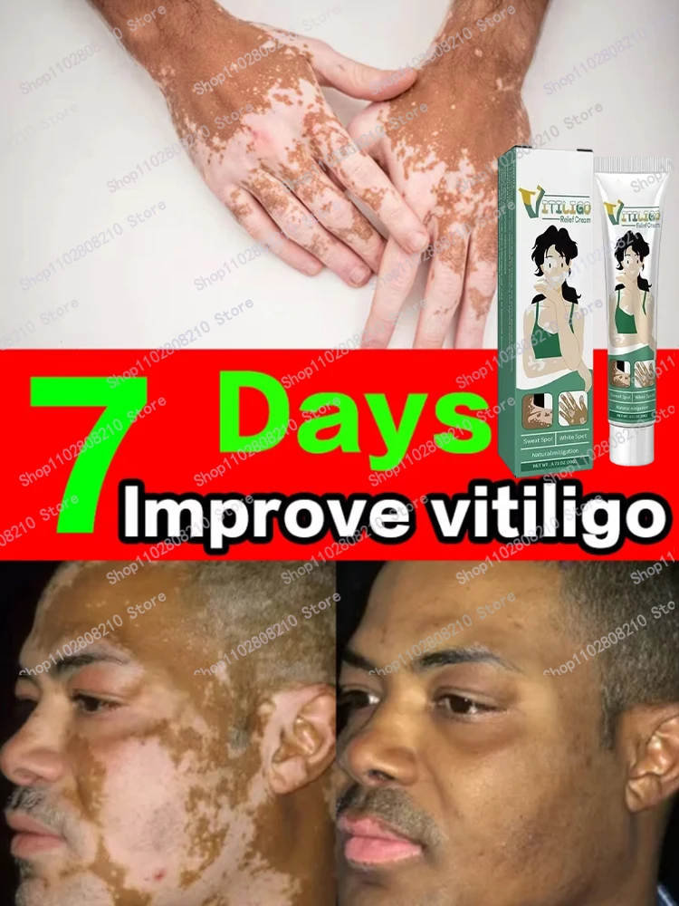 

Reduce White Spots Eliminate Vitiligo Skin Care Products