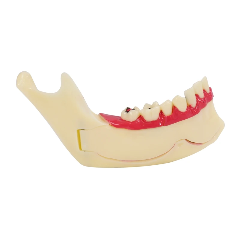 Treatment Model Anatomy Of Gums  Study Teach Teeth Model