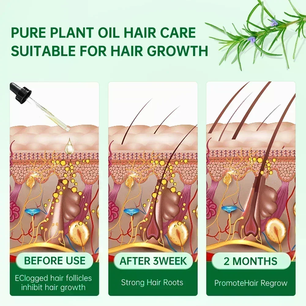 Productos para el crecimiento del cabello Biotina Anti pérdida de cabello Spray cuero cabelludo aceites esenciales de crecimiento rápido cuidado del cabello