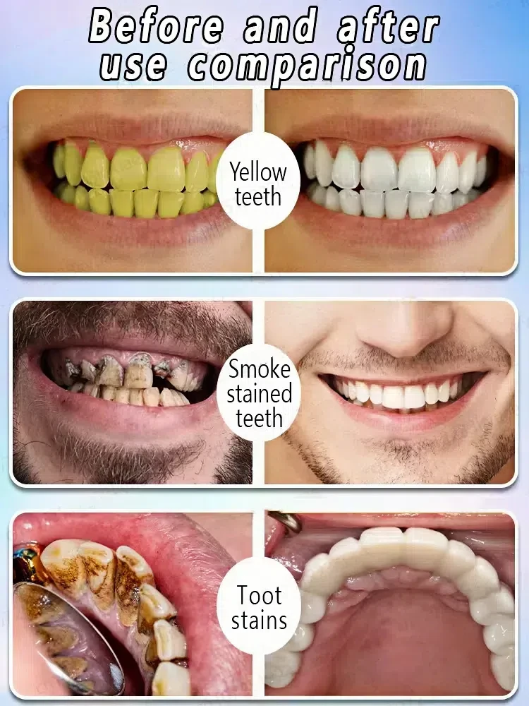 Reparar fácilmente las cariesPreviene la cariesblanquea los dientes