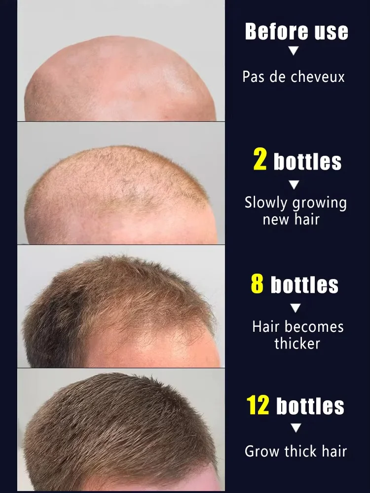 100% revive cabelo, penetração forte, atire as raízes do cabelo, mais cabelo, diga adeus à calvície, cabelos grossos