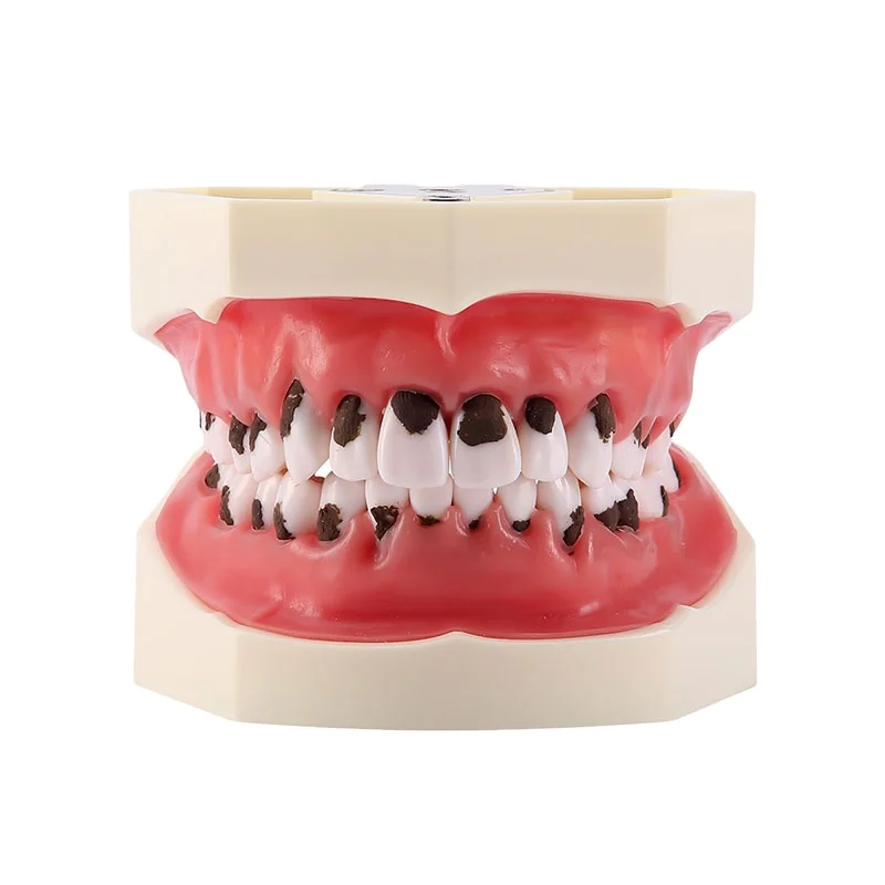 Dental Teaching Model Dental Calculus Model