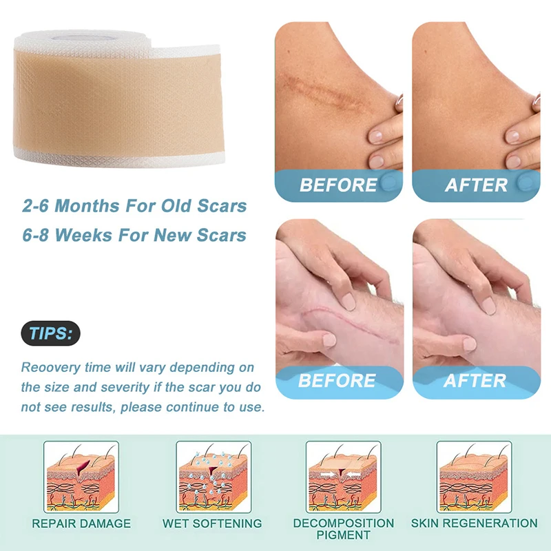 1 Roll  Grade Silicone Scar Tape Painless Reusable Surgical Scar Repair Soft Silicone Patch
