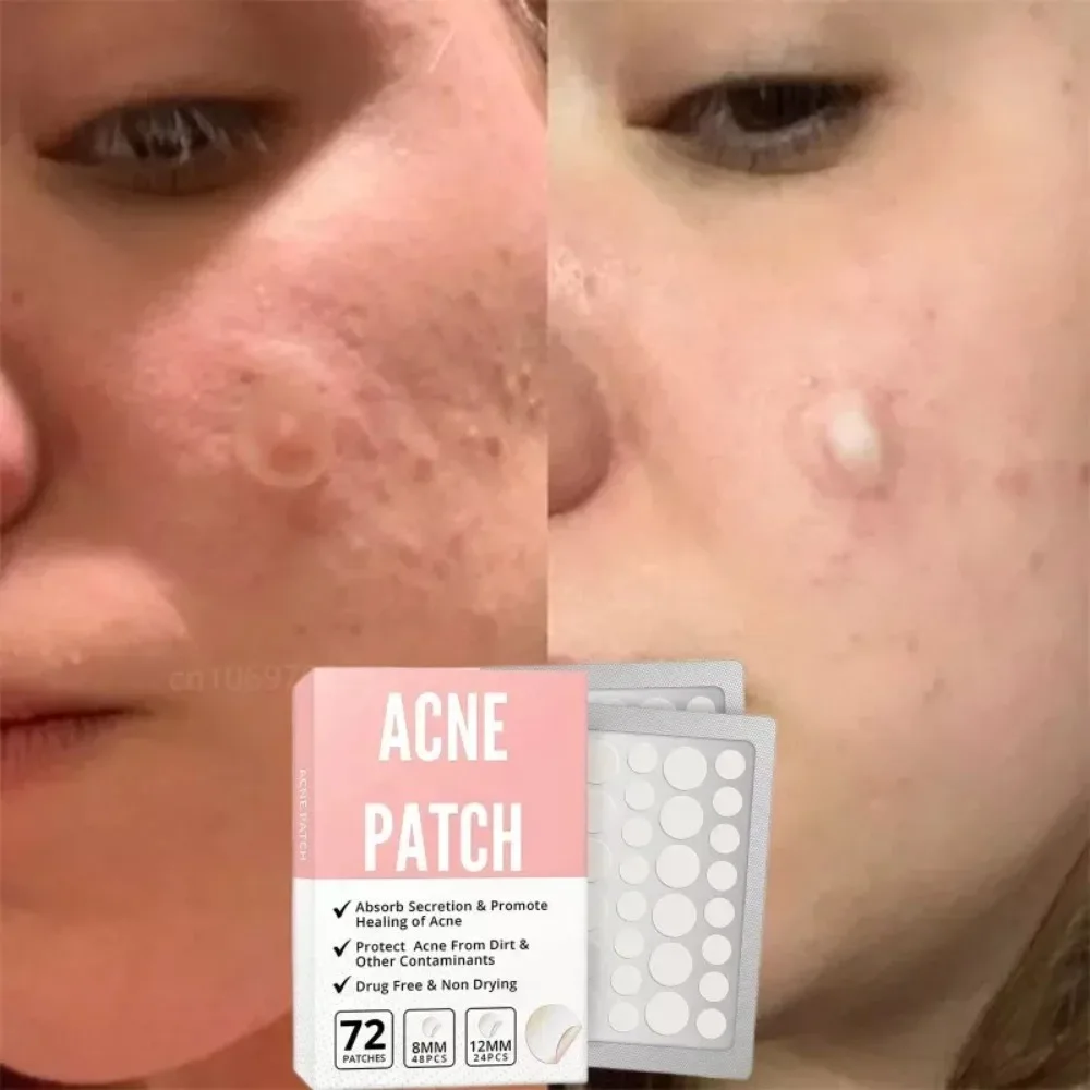 72 ชิ้นแผ่นแปะสิวใบหน้ารอยแดงซ่อมแซมสิวทำความสะอาดรูขุมขนให้ความชุ่มชื้นและผิวเรียบเนียนสิวแพทช์สติกเกอร์ใบหน้าเครื่องมือดูแลผิว