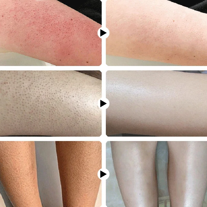 Keratosis Pilaris Repair Treatment Cream Exfoliating Removal Chicken Skin Cleaning Acne Spots Moisturizing Smooth Body Skin Care