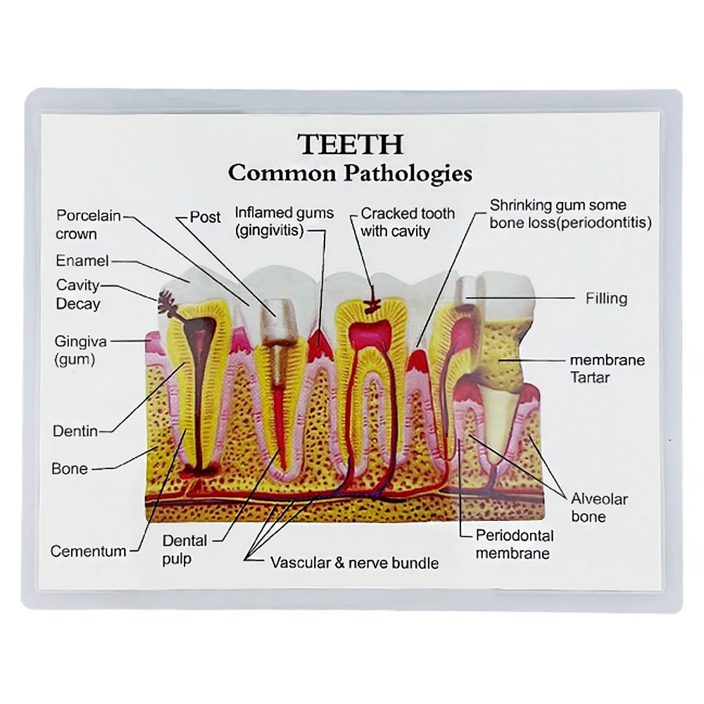 Anatomical Structure Dental Model Standard Dental Oral Teeth Teaching Model Student Demonstration Dental Anatomy Caries Model