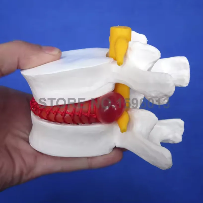 Vertebrae Models in 3 Stages of Degeneration medical Lumbar vertebra lesion model Normal state CMAM VERTEBRA12 Life-size Lumbar