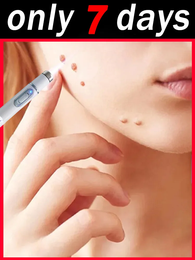 

2025 New Upgrade Blue Laser Solve Wart Tool