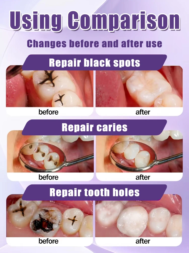 Dentes Decay reparação