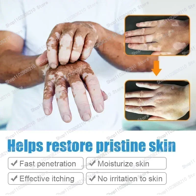 Organic Vitiligo Treatment With Herbal Extract for White Spot Ringworm Removal