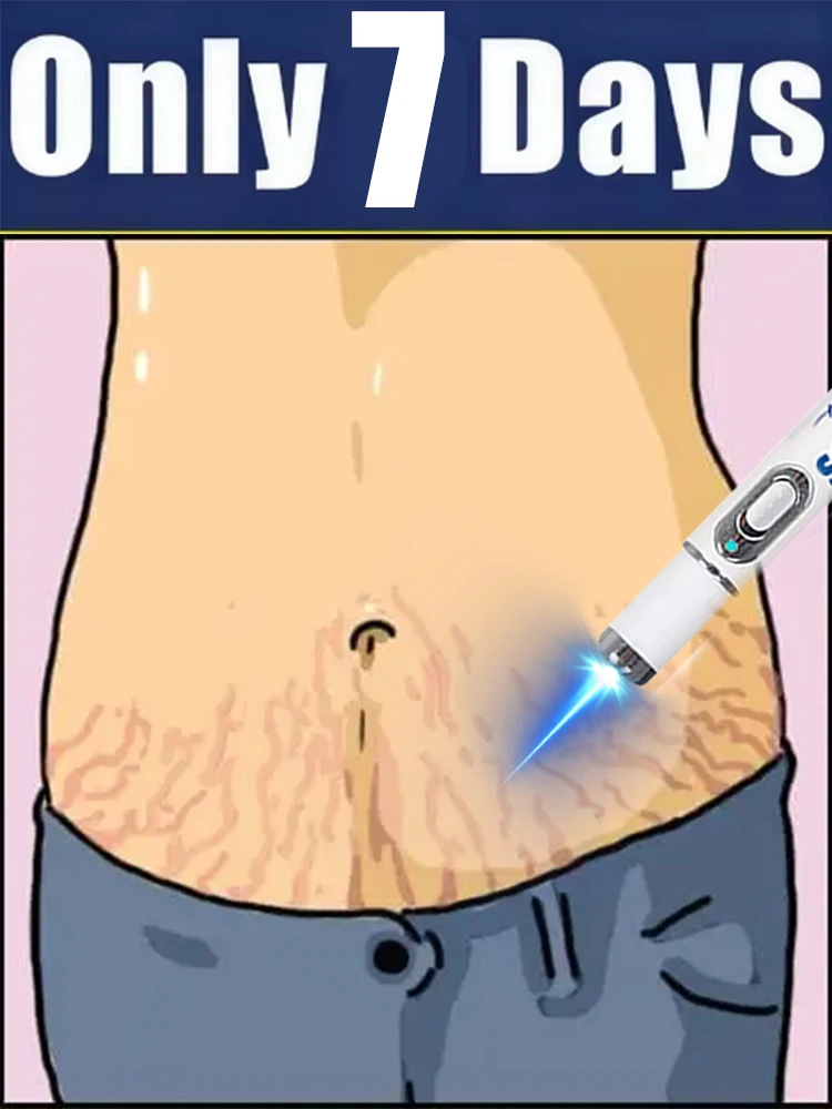 Envío gratis, ayuda a personas con estrías, resuelve sus problemas y sin problemas, herramienta de bolígrafo con luz azul