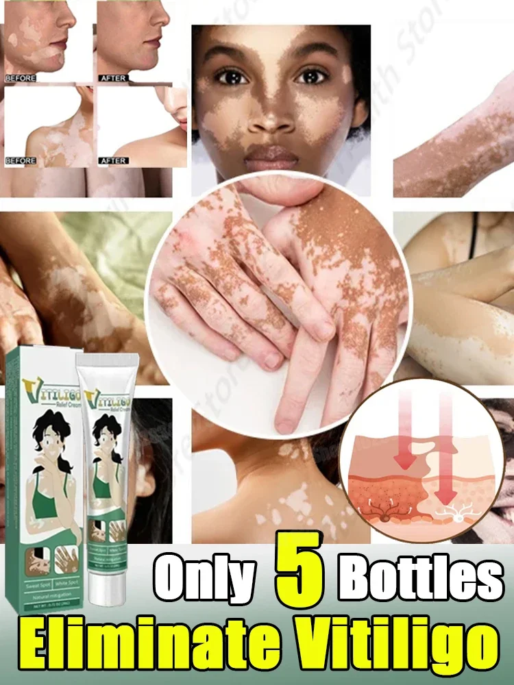 

Vitiligo Skin Cream Help Skin Treatment Melanin Promotes Pigmentation Mela Gain